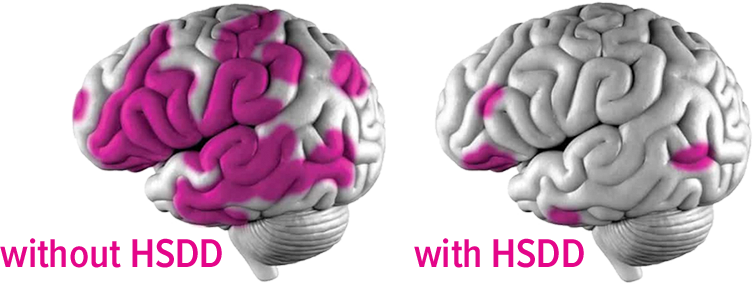 Representation of the brain comparison with HSDD and without HSDD